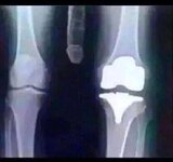 toms bad knee.jpg